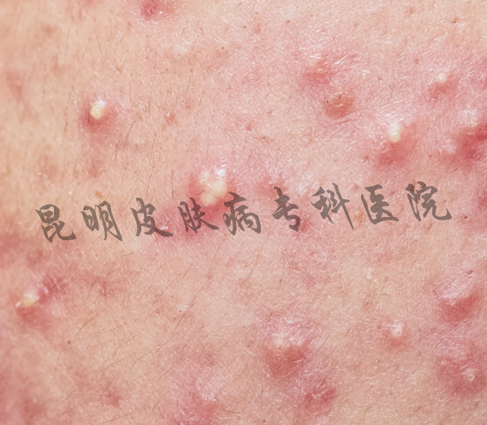 1630477033435525.png 脓包型.png