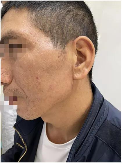昆明知名好的疤痕医院 疤痕专科正规昆明