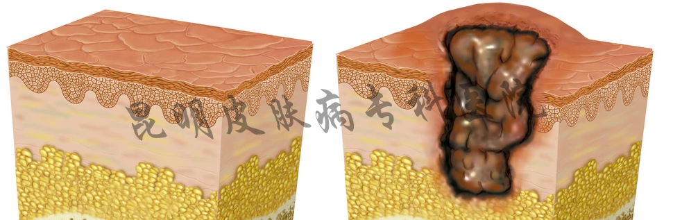 昆明好的疤痕在哪里 昆明谁家疤痕病医院好