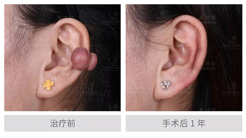 云南去哪里看疤痕疙瘩 昆明哪里治疗疤痕疙瘩最好