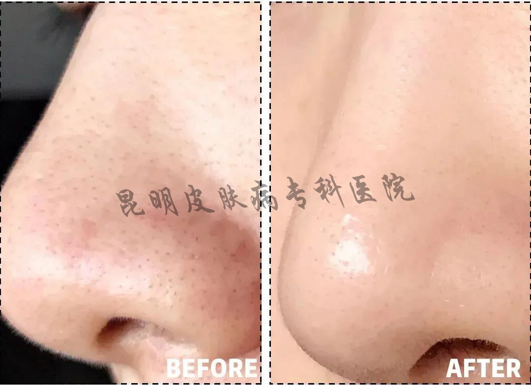 昆明疤痕病医院哪家好一点 昆明看疤痕病的医院