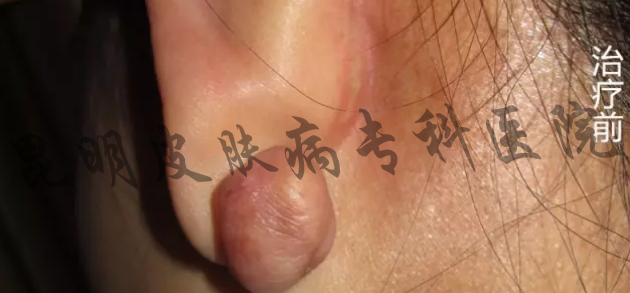疤痕疙瘩长什么样 疤痕疙瘩能治疗好吗