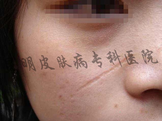 昆明哪里可以治疗凹陷性疤痕 治疗疤痕应该去哪里