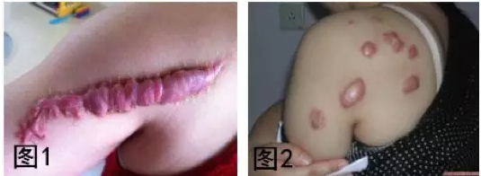 昆明治疗疤痕病医院哪家好 昆明厉害的疤痕医院