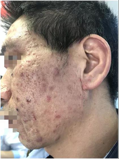 云南最权威的疤痕病医院 昆明谁家疤痕病医院好