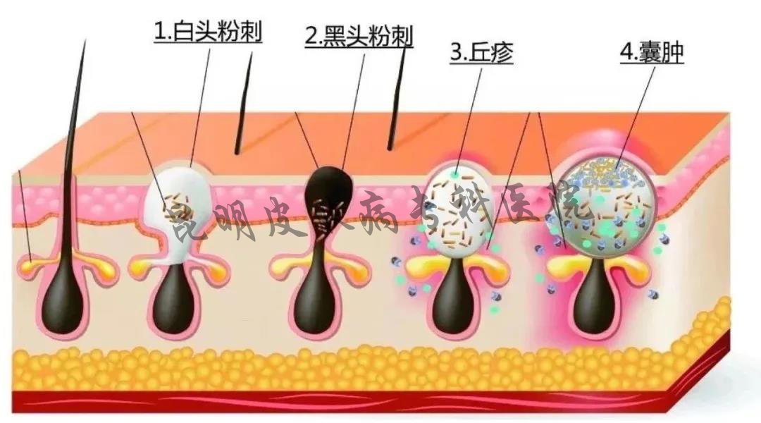 昆明疤痕正规治疗医院 昆明哪家医院看疤痕病看的好