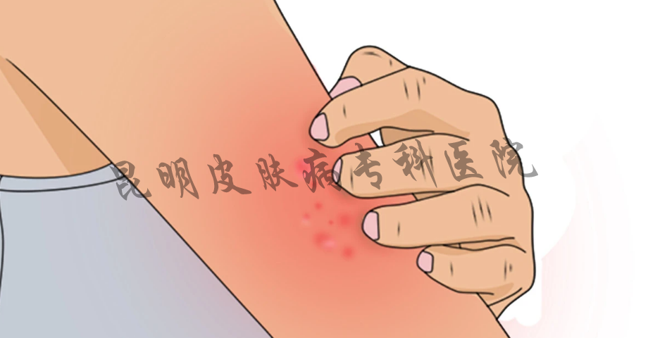 昆明看疤痕去哪里 云南治疗疤痕哪里好