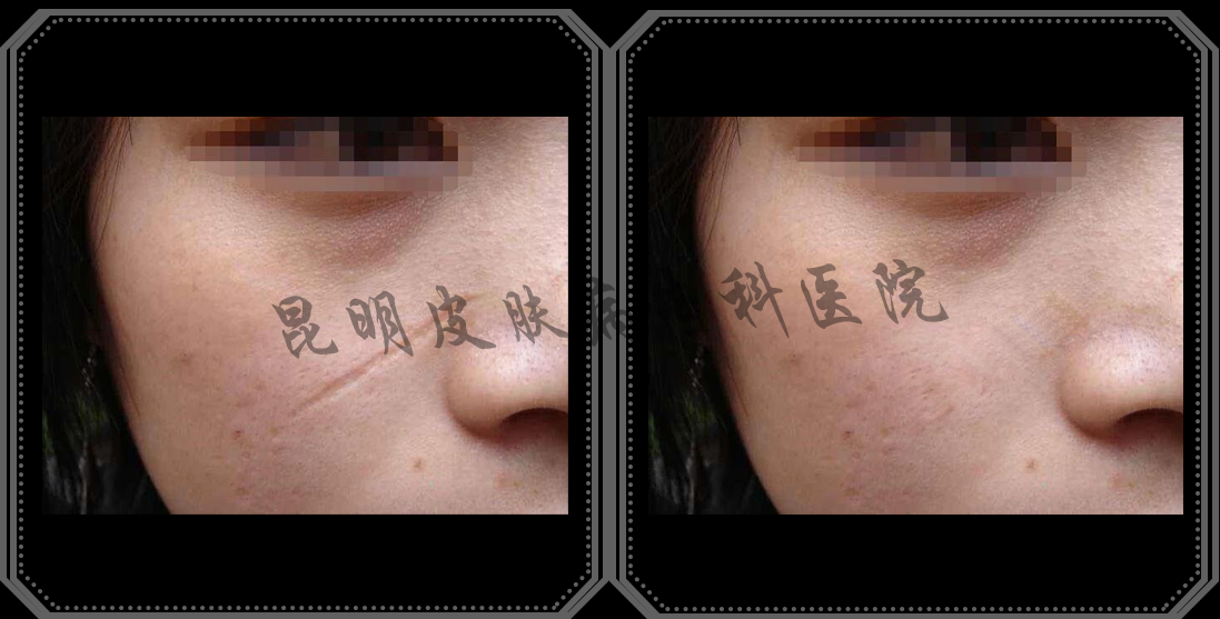 昆明哪里看凹陷性疤痕看的好 凹陷性疤痕可以治好吗