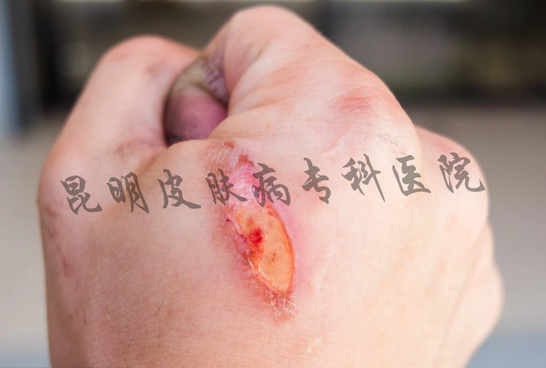 云南最权威的疤痕病医院 昆明疤痕病医院治疗医院