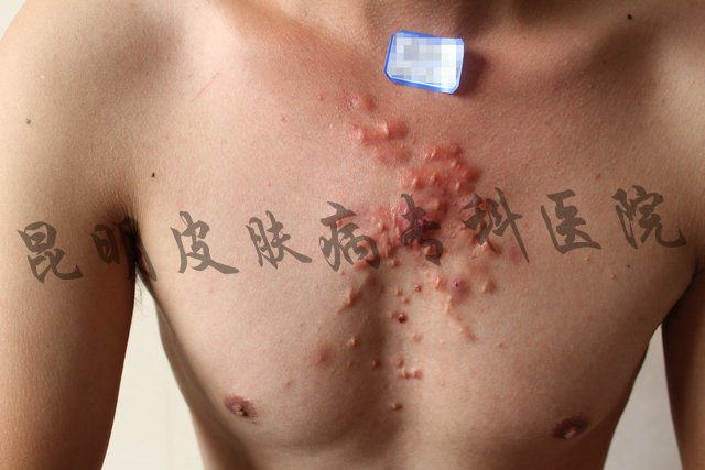 昆明疤痕病医院哪家好一点 昆明各大医院疤痕的专科
